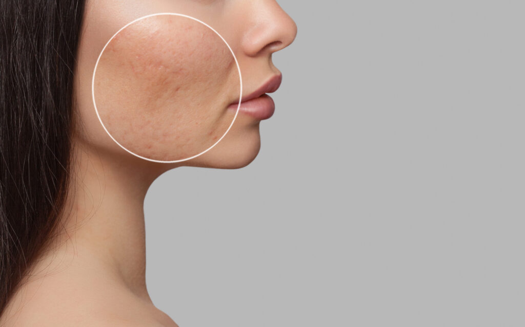 Does Salicylic Acid Help With Acne