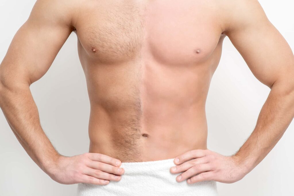 Before and after laser hair removal results at ND Skin Aesthetics Leicester