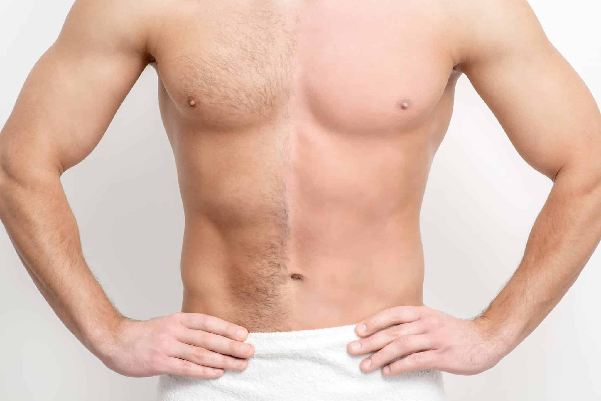 laser hair removal in Leicester