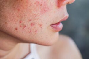 Does Salicylic Acid Help With Acne