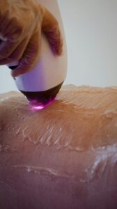 Does Laser Hair Removal Work on Blonde Hair