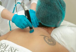 How Many Sessions to Remove a Tattoo