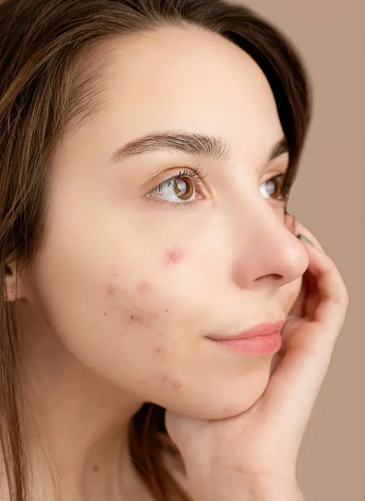 Acne on One Side of the Face