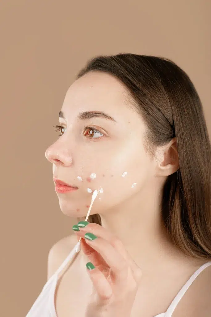 Acne on One Side of the Face