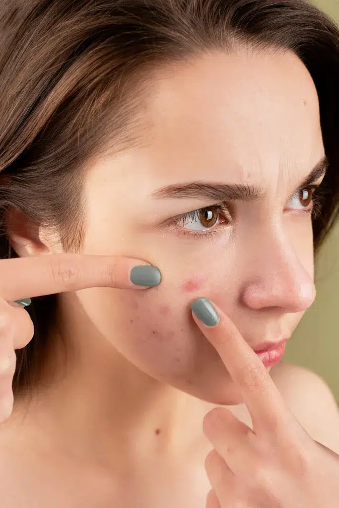 Acne on One Side of the Face? Find Out the Real Reason!