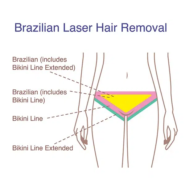 Brazilian Laser Hair Removal: Benefits, Process & Secrets Revealed!