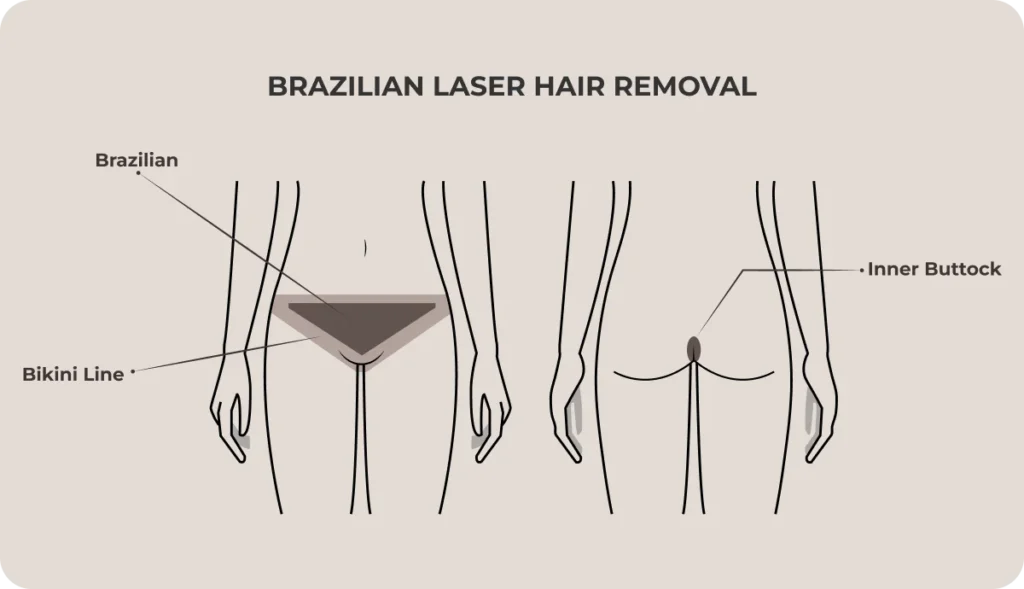 Brazilian Laser Hair Removal
